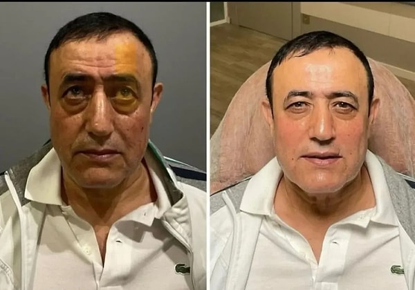 unlu isimden carpici itiraf mahmut tuncere sesini kaybetmesi icin uygulanan yontem midenizi altust edecek NMF9GTHV