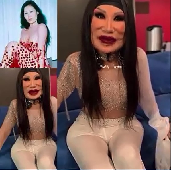 yuzune yemeklik yag enjekte edildigi icin hayati cehenneme donen oyuncunun son hali sasirtti 5 I7r75mBz