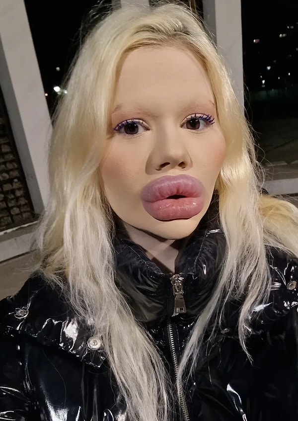 32 Ameliyat Sonrası 'Dünyanın En Büyük Dudaklı Kadını' Olan Andrea Ivanova X'te Goygoyseverlere Malzeme Oldu! 2 32 ameliyat sonrasi dunyanin en buyuk dudakli kadini olan andrea ivanova xte goygoyseverlere malzeme 5ZBtn5BD