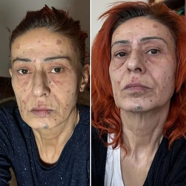 Saç Boyası Nedeniyle Yüzünde Yanıklar Oluşan Yıldız Tilbe, Taktığı Taşlı Maske ile Dikkatleri Üzerine Çekti 2 sac boyasi nedeniyle yuzunde yaniklar olusan yildiz tilbe taktigi tasli maske ile dikkatleri uzerine Kc2uztpD