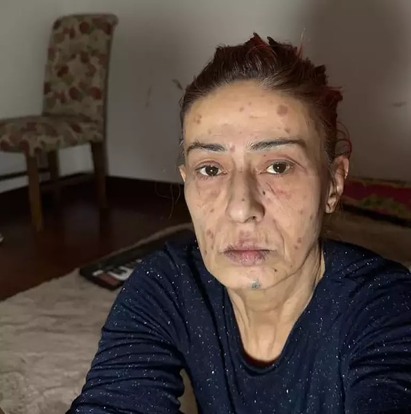 Saç Boyası Nedeniyle Yüzünde Yanıklar Oluşan Yıldız Tilbe, Taktığı Taşlı Maske ile Dikkatleri Üzerine Çekti 1 sac boyasi nedeniyle yuzunde yaniklar olusan yildiz tilbe taktigi tasli maske ile dikkatleri uzerine
