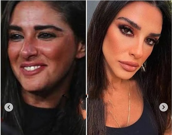 Adeta Bambaşka Birine Dönüşmüş: Arda Turan'ın Eşi Aslıhan Doğan Turan'ın Estetiklerini Tek Tek Açıklıyoruz! 3 adeta bambaska birine donusmus arda turanin esi aslihan dogan turanin estetiklerini tek tek acikliyoruz W3BPlNUJ