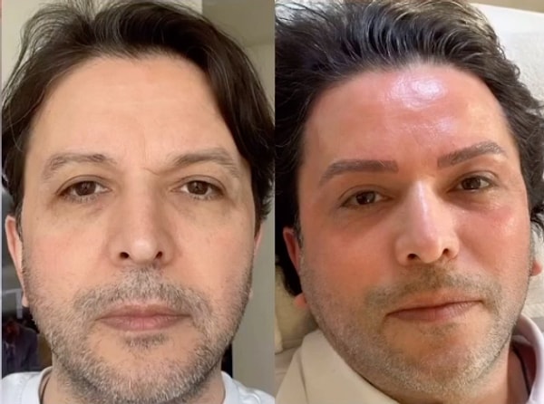 Yüzünü Görenler Şoke Oldu: Kaşlarına İşlem Yaptıran Nihat Doğan'ın Son Hali Tatları Fena Halde Kaçırdı! 2 yuzunu gorenler soke oldu kaslarina islem yaptiran nihat doganin son hali tatlari fena halde vYfRbATa